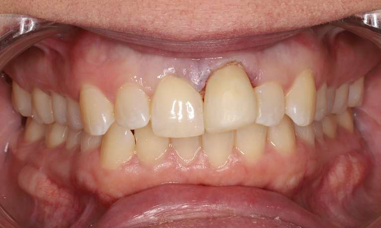 Clear-Aligners-Before-a-Crown-Replacement-Before-Image