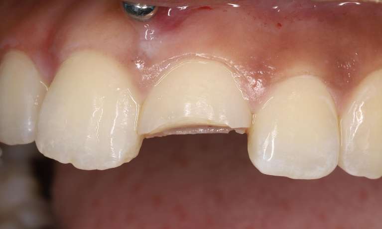 Fractured tooth with exposed pulp
