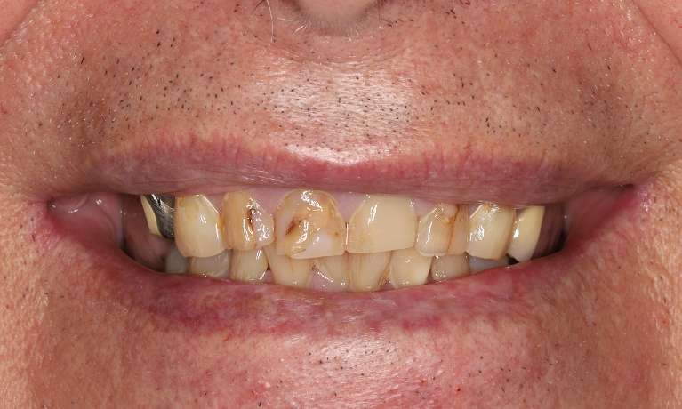 Upper-and-Lower-Implant-Retained-Overdentures-Before-Image