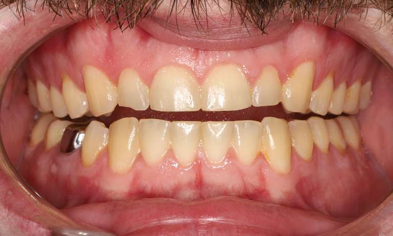 Before treatment with direct composite veneers