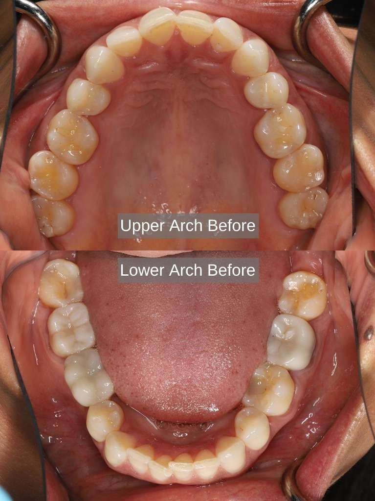 Before Aligners, Bleaching, Composite Bonding