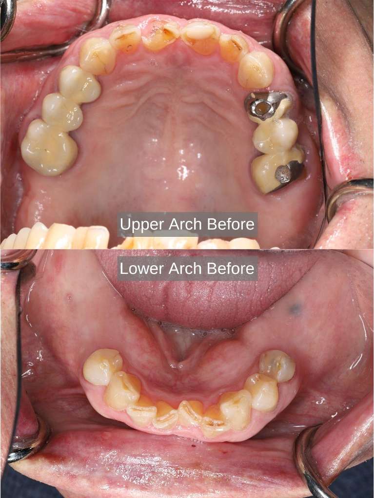 Before treatment, multiple decayed, chipped, missing teeth